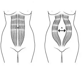 腹直肌分离的肚子图片